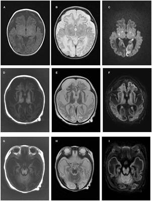 Clinical and Genetic Characteristics of Mitochondrial Encephalopathy Due to FOXRED1 Mutations: Two Chinese Case Reports and a Review of the Literature